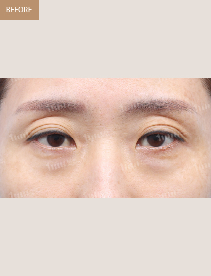 Before