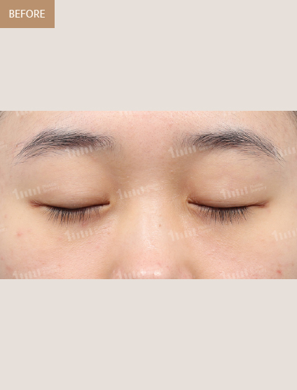 Before