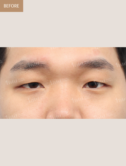 Before