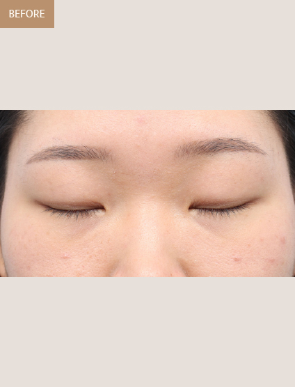 Before