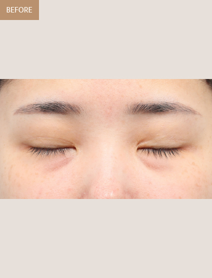 Before