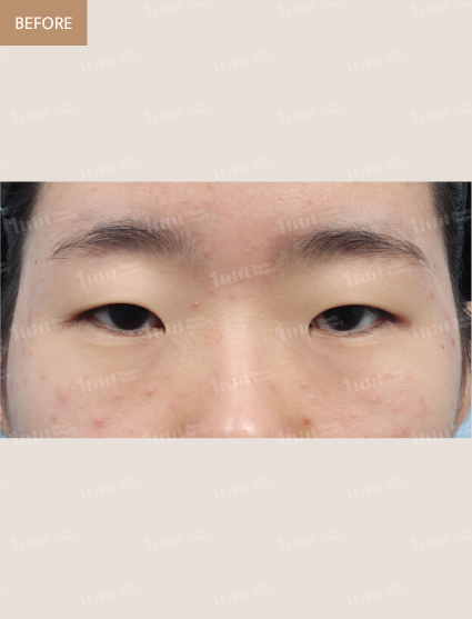Before