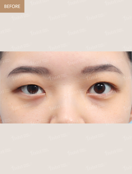 Before