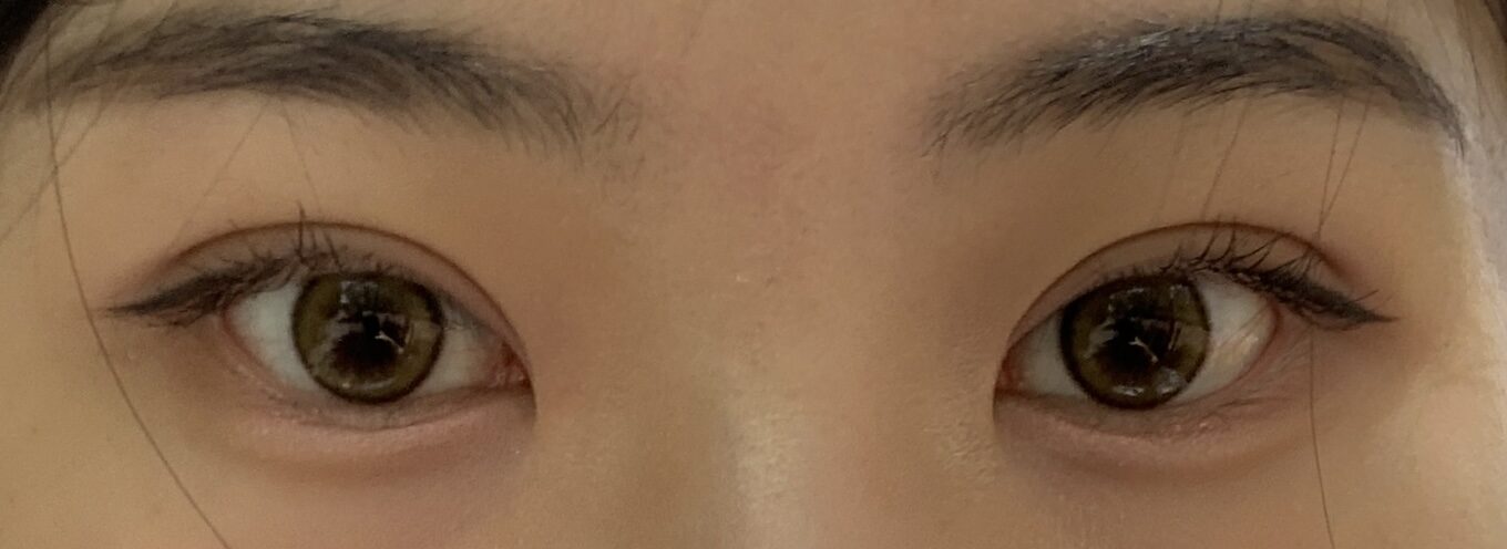 수술후