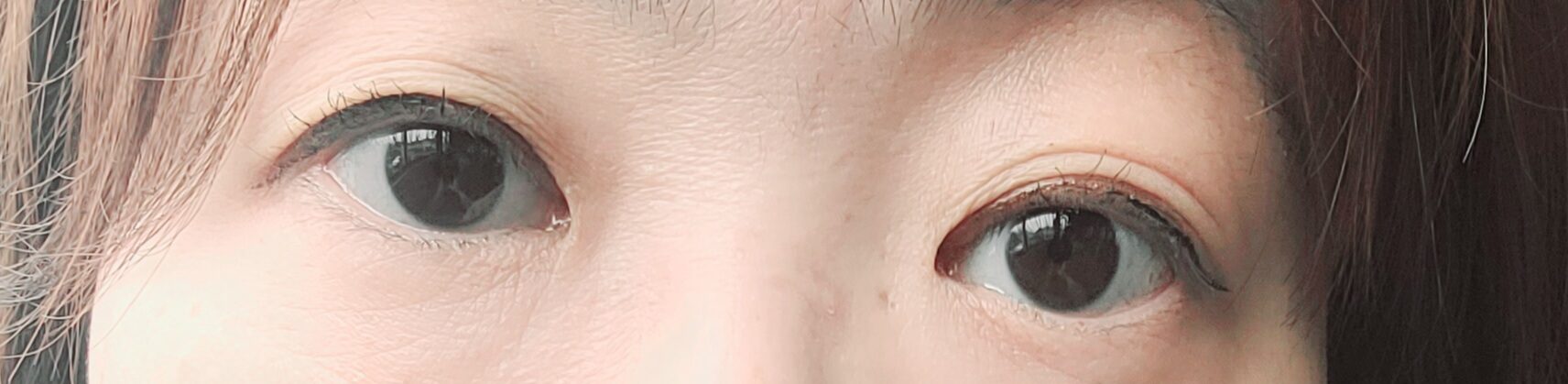 수술전