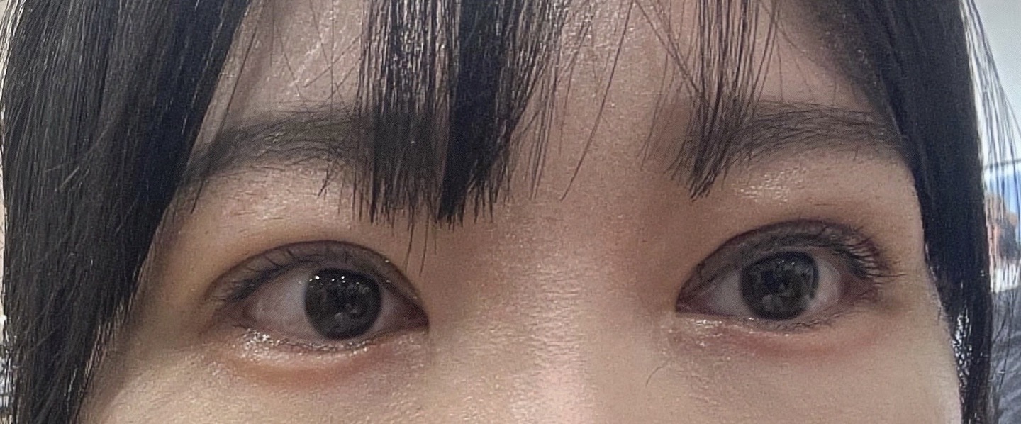 눈 재수술 후!(재수술을 3번해서 사진상 오른쪽만 실밥을 안푼 상태입니다!)
