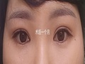 都彦禄 院长/切开式双眼皮修复手术