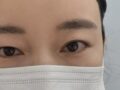 Hongjin Kim 醫師的埋眼手術心得