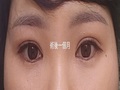Dr. 都彥錄/切口雙眼皮修復手術