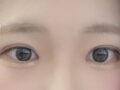 雙眼皮再手術（切開術）、前開內眼角手術（再手術）、提眼瞼肌矯正複查